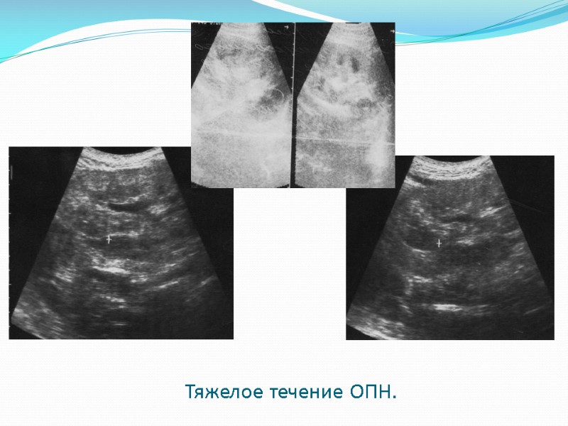 Тяжелое течение ОПН.